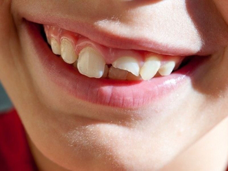 Mơ thấy mẻ và gãy răng